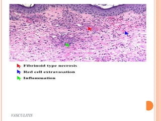 VASCULITIS 
 