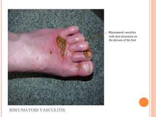 RHEUMATOID VASCULITIS 
Rheumatoid vasculitis 
with skin ulceration on 
the dorsum of the foot 
 