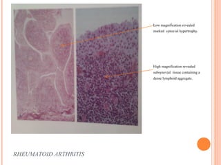 RHEUMATOID ARTHRITIS 
Low magnification revealed 
marked synovial hypertrophy. 
High magnification revealed 
subsynovial tissue containing a 
dense lymphoid aggregate. 
 