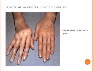 CLINICAL APPEARANCE OF RHEUMATOID ARTHRITIS 
variety & plurality of affection of 
joints 
 