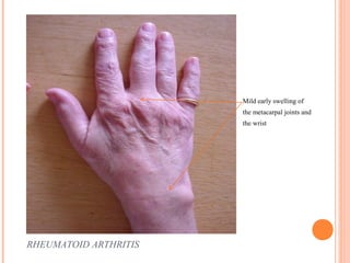 RHEUMATOID ARTHRITIS 
Mild early swelling of 
the metacarpal joints and 
the wrist 
 