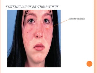 SYSTEMIC LUPUS ERYTHEMATOSUS 
Butterfly skin rash 
 