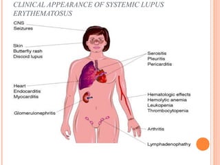 CLINICAL APPEARANCE OF SYSTEMIC LUPUS 
ERYTHEMATOSUS 
 