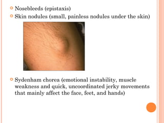  Nosebleeds (epistaxis) 
 Skin nodules (small, painless nodules under the skin) 
 Sydenham chorea (emotional instability, muscle 
weakness and quick, uncoordinated jerky movements 
that mainly affect the face, feet, and hands) 
 