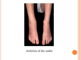 Arthritis of the ankle 
 