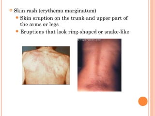  Skin rash (erythema marginatum) 
Skin eruption on the trunk and upper part of 
the arms or legs 
Eruptions that look ring-shaped or snake-like 
 
