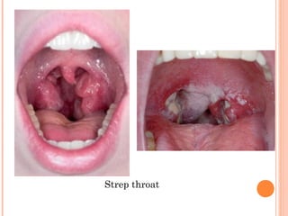 Strep throat 
 