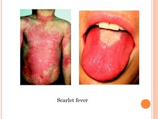 Scarlet fever 
 