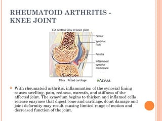 RHEUMATOID ARTHRITIS - 
KNEE JOINT 
 With rheumatoid arthritis, inflammation of the synovial lining 
causes swelling, pain, redness, warmth, and stiffness of the 
affected joint. The synovium begins to thicken and inflamed cells 
release enzymes that digest bone and cartilage. Joint damage and 
joint deformity may result causing limited range of motion and 
decreased function of the joint. 
 