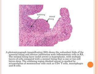 A photomicrograph (magnification 200) shows the redundant folds of the 
synovial lining and intense infiltration with inflammatory cells in RA. 
The intimal lining layer (solid arrow) is hyperplastic, with multiple 
layers of cells compared with a normal lining that is one or two cell 
layers deep. The sublining region (dashed arrow) is marked by 
accumulation of mononuclear cells such as CD4+ T cells, macrophages 
and B cells. 
 