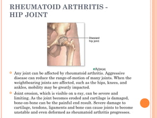 RHEUMATOID ARTHRITIS - 
HIP JOINT 
 Any joint can be affected by rheumatoid arthritis. Aggressive 
disease can reduce the range-of-motion of many joints. When the 
weightbearing joints are affected, such as the hips, knees, and 
ankles, mobility may be greatly impacted. 
 Joint erosion, which is visible on x-ray, can be severe and 
limiting. As the joint becomes eroded and cartilage is damaged, 
bone-on-bone can be the painful end result. Severe damage to 
cartilage, tendons, ligaments and bone can cause joints to become 
unstable and even deformed as rheumatoid arthritis progresses. 
 