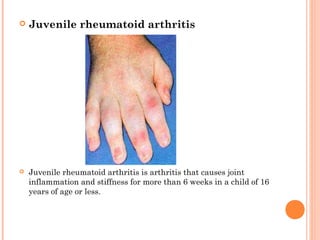  Juvenile rheumatoid arthritis 
 Juvenile rheumatoid arthritis is arthritis that causes joint 
inflammation and stiffness for more than 6 weeks in a child of 16 
years of age or less. 
 
