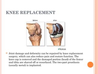 KNEE REPLACEMENT 
 Joint damage and deformity can be repaired by knee replacement 
surgery, which can also reduce pain and restore function. The 
knee cap is removed and the damaged portion (head) of the femur 
and tibia are shaved off or resurfaced. The two-part prosthesis 
(usually metal) is implanted. 
 