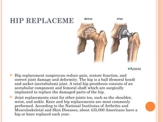 HIP REPLACEMENT 
 Hip replacement surgerycan reduce pain, restore function, and 
correct joint damage and deformity. The hip is a ball (femoral head) 
and socket (acetabulum) joint. A total hip prosthesis consists of an 
acetabular component and femoral shaft which are surgically 
implanted to replace the damaged parts of the hip. 
 Joint replacements exist for other joints too, such as the shoulder, 
wrist, and ankle. Knee and hip replacements are most commonly 
performed. According to the National Institutes of Arthritis and 
Musculoskeletal and Skin Diseases, about 435,000 Americans have a 
hip or knee replaced each year. 
 