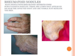 RHEUMATOID NODULES 
MANY PEOPLE WITH RHEUMATOID ARTHRITIS FORM 
SUBCUTANEOUS NODULES. THESE ARE LUMPS THAT APPEAR ON 
OR NEAR THE AFFECTED JOINT AND ARE VISIBLE JUST BENEATH 
THE SKIN. 
 