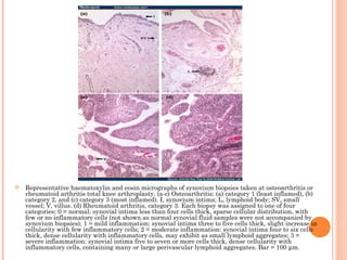  Representative haematoxylin and eosin micrographs of synovium biopsies taken at osteoarthritis or 
rheumatoid arthritis total knee arthroplasty. (a-c) Osteoarthritis: (a) category 1 (least inflamed), (b) 
category 2, and (c) category 3 (most inflamed). I, synovium intima; L, lymphoid body; SV, small 
vessel; V, villus. (d) Rheumatoid arthritis, category 3. Each biopsy was assigned to one of four 
categories: 0 = normal: synovial intima less than four cells thick, sparse cellular distribution, with 
few or no inflammatory cells (not shown as normal synovial fluid samples were not accompanied by 
synovium biopsies); 1 = mild inflammation: synovial intima three to five cells thick, slight increase in 
cellularity with few inflammatory cells; 2 = moderate inflammation: synovial intima four to six cells 
thick, dense cellularity with inflammatory cells, may exhibit as small lymphoid aggregates; 3 = 
severe inflammation: synovial intima five to seven or more cells thick, dense cellularity with 
inflammatory cells, containing many or large perivascular lymphoid aggregates. Bar = 100 μm. 
 