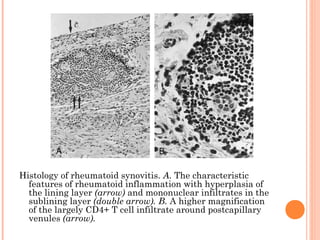Histology of rheumatoid synovitis. A. The characteristic 
features of rheumatoid inflammation with hyperplasia of 
the lining layer (arrow) and mononuclear infiltrates in the 
sublining layer (double arrow). B. A higher magnification 
of the largely CD4+ T cell infiltrate around postcapillary 
venules (arrow). 

