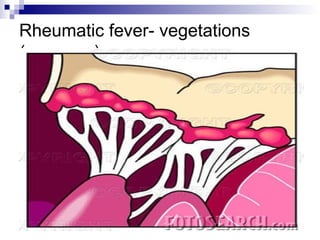 Rheumatic fever- vegetations
(verrucae)
 