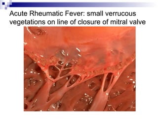 Acute Rheumatic Fever: small verrucous
vegetations on line of closure of mitral valve
 