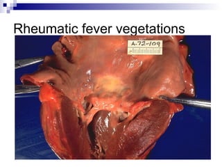 Rheumatic fever vegetations
 