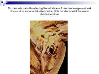 Ch.rheumatic valvulitis affecting the mitral valve & dev due to organization &
fibrosis of ac endocardial inflammation. Note the shortened & thickened
chordae tendinae
 