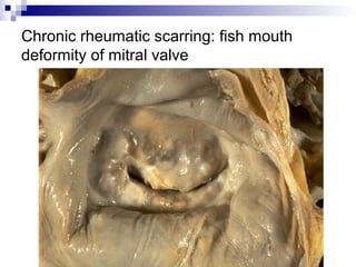 Chronic rheumatic scarring: fish mouth
deformity of mitral valve
 