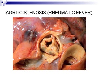 AORTIC STENOSIS (RHEUMATIC FEVER)
 