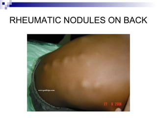 RHEUMATIC NODULES ON BACK
 