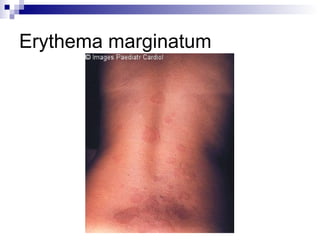 Erythema marginatum
 
