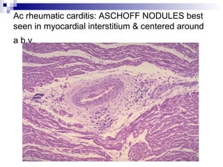 Ac rheumatic carditis: ASCHOFF NODULES best
seen in myocardial interstitium & centered around
a b.v.
 