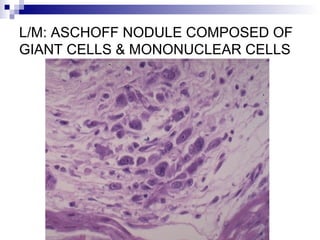 L/M: ASCHOFF NODULE COMPOSED OF
GIANT CELLS & MONONUCLEAR CELLS
 