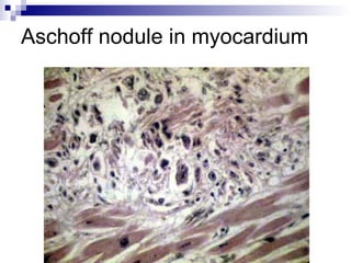 Aschoff nodule in myocardium
 
