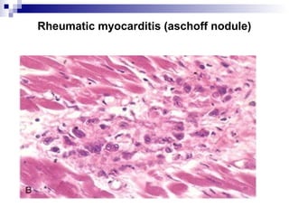 Rheumatic myocarditis (aschoff nodule)
 