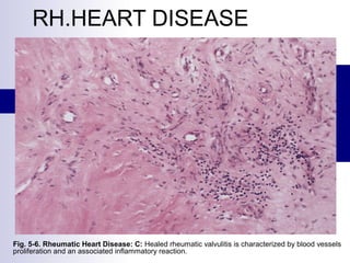 RH.HEART DISEASE
Fig. 5-6. Rheumatic Heart Disease: C: Healed rheumatic valvulitis is characterized by blood vessels
proliferation and an associated inflammatory reaction.
 