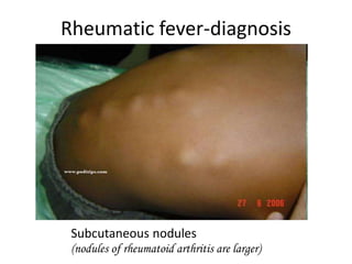 Rheumatic fever-diagnosis
Subcutaneous nodules
(nodules of rheumatoid arthritis are larger)
 