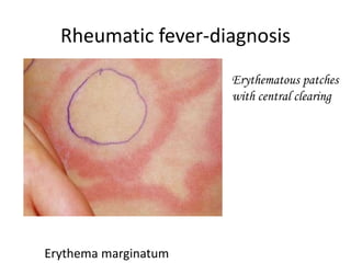 Rheumatic fever-diagnosis
Erythema marginatum
Erythematous patches
with central clearing
 