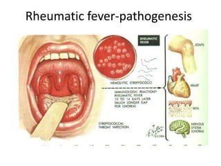 Rheumatic fever-pathogenesis
 