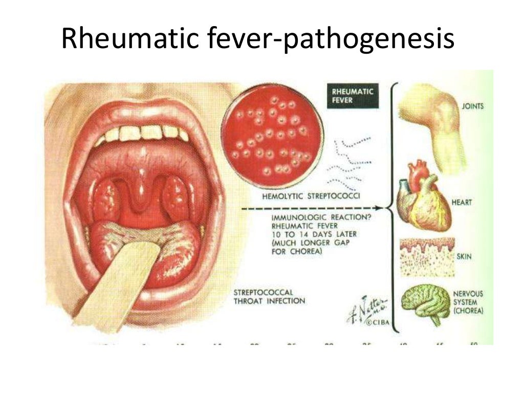 rheumatic-fever