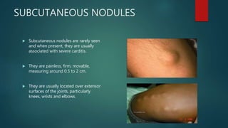SUBCUTANEOUS NODULES
 Subcutaneous nodules are rarely seen
and when present, they are usually
associated with severe carditis.
 They are painless, firm, movable,
measuring around 0.5 to 2 cm.
 They are usually located over extensor
surfaces of the joints, particularly
knees, wrists and elbows.
 