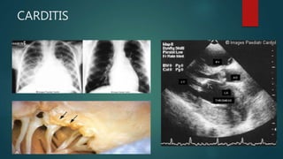 CARDITIS
 
