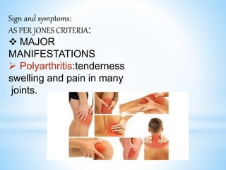 Sign and symptoms:
AS PER JONES CRITERIA:
 MAJOR
MANIFESTATIONS
 Polyarthritis:tenderness
swelling and pain in many
joints.
 