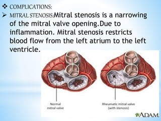  COMPLICATIONS:
 MITRAL STENOSIS:Mitral stenosis is a narrowing
of the mitral valve opening.Due to
inflammation. Mitral stenosis restricts
blood flow from the left atrium to the left
ventricle.
 