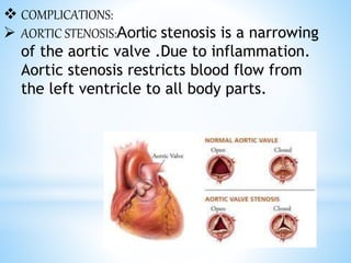  COMPLICATIONS:
 AORTIC STENOSIS:Aortic stenosis is a narrowing
of the aortic valve .Due to inflammation.
Aortic stenosis restricts blood flow from
the left ventricle to all body parts.
 