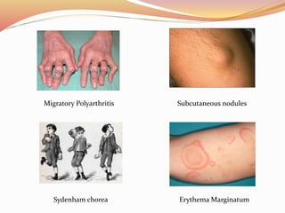 Migratory Polyarthritis Subcutaneous nodules
Sydenham chorea Erythema Marginatum
 