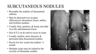 SUBCUTANEOUS NODULES
• Resemble the nodules of rheumatoid
arthritis
• May be detected over occiput,
elbows(over olecranon), knees, ankles,
and Achilles tandons.
• Usually firm, painless, & freely movable
over the subcutaneous tissue
• Size 0.5-2 cm & tend to occur in crops
• Usually smaller, more discrete, &
persistent than rheumatoid nodules
• Persist for few weeks but seldom >1
month
• Multiple crops may be related to the
severity of rheumatic carditis
 