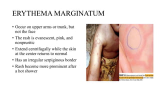 ERYTHEMA MARGINATUM
• Occur on upper arms or trunk, but
not the face
• The rash is evanescent, pink, and
nonpruritic
• Extend centrifugally while the skin
at the center returns to normal
• Has an irregular serpiginous border
• Rash become more prominent after
a hot shower
 