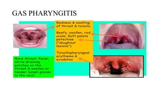 GAS PHARYNGITIS
 
