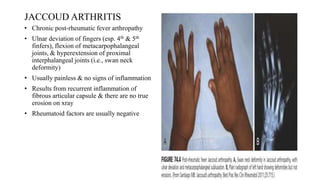 JACCOUD ARTHRITIS
• Chronic post-rheumatic fever arthropathy
• Ulnar deviation of fingers (esp. 4th & 5th
finfers), flexion of metacarpophalangeal
joints, & hyperextension of proximal
interphalangeal joints (i.e., swan neck
deformity)
• Usually painless & no signs of inflammation
• Results from recurrent inflammation of
fibrous articular capsule & there are no true
erosion on xray
• Rheumatoid factors are usually negative
 