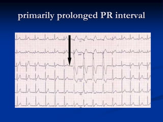 primarily prolonged PR interval
 