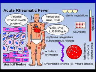 Rheumatic  Fever 2023 May.pdf